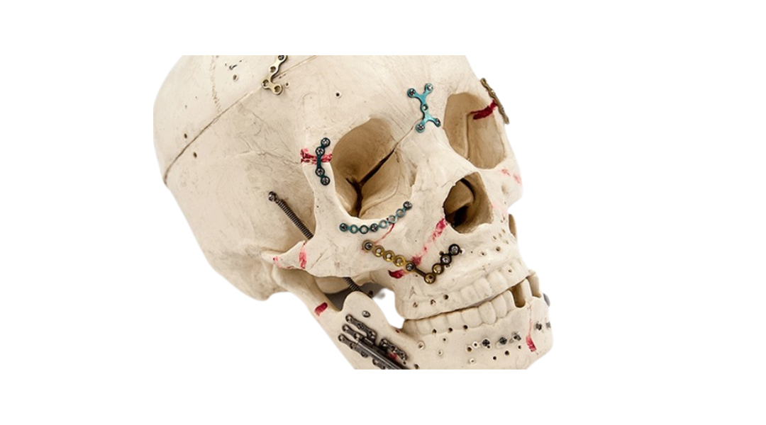 Craniomaxillofacial Implants