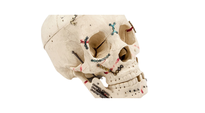 Craniomaxillofacial Implants